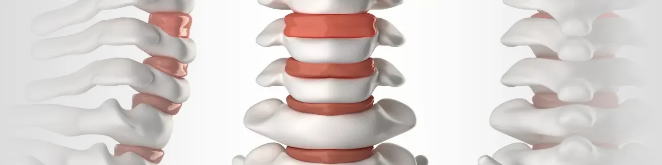 Spinal Stenosis Treatment Near Me in Boulder, CO. Chiroprator For Spinal Stenosis Pain Relief.