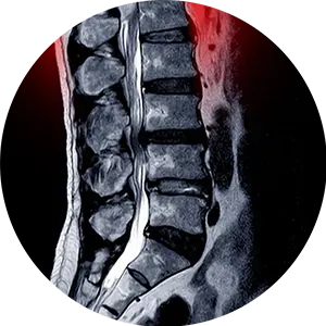 Spinal Stenosis Treatment Near Me in Boulder, CO. Chiropractor For Spinal Stenosis Pain Relief.